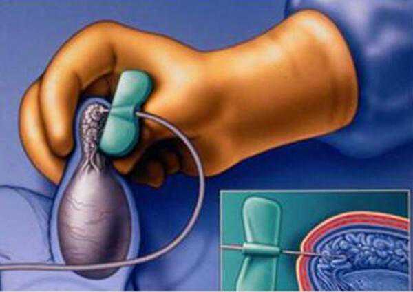 鲜胚分为几个级别：鲜胚胚胎评分等级-助孕机构费用价格