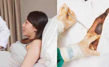 重庆输卵管有积液怎么治医院-助孕供卵代生