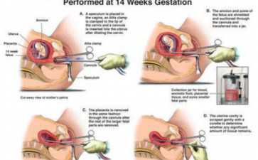 广州试管婴儿移植后失败的主要原因有哪些